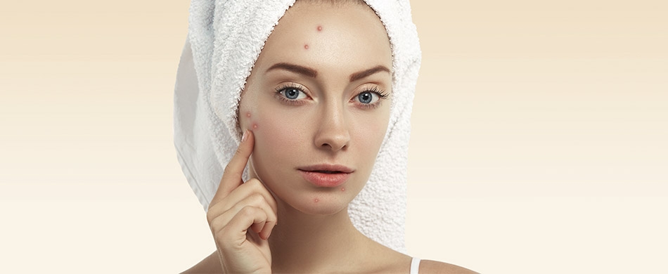 A acne é uma doença de pele busque o dermatologista